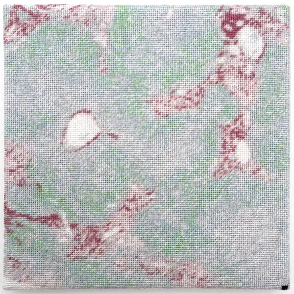 Fibrose hépatique